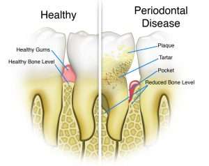 The Difference Between Healthy Gums and Teeth and Those Affected with Periodontal Disease