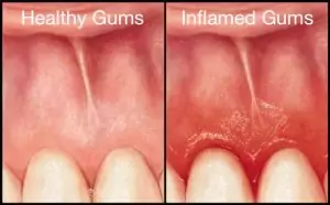 Healthy Gums versus Inflamed Gums
