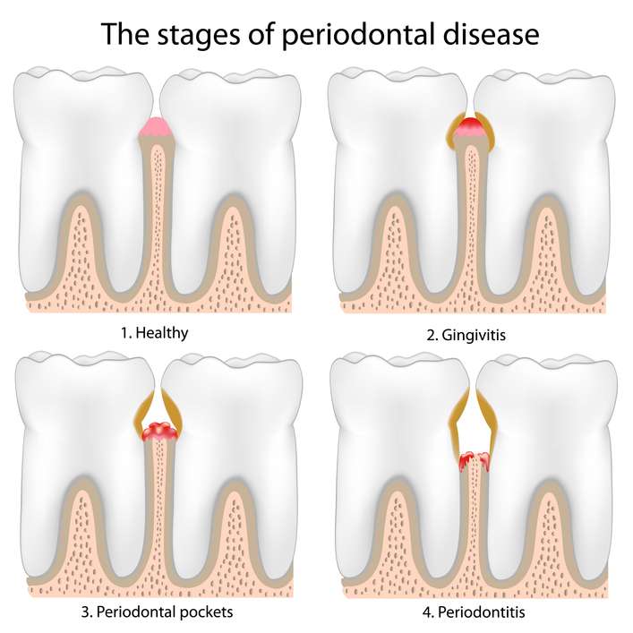 Stages of Periodontal Disease