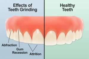 Effects of Teeth Grinding
