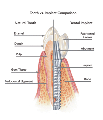 Tooth Vs Implant Comparison