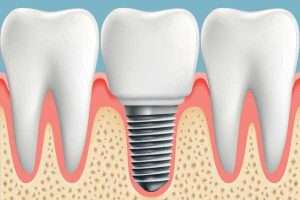 How Air Flow Therapy Can Save Your Dental Implants