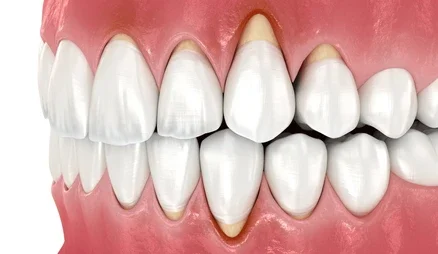 gingival recession
