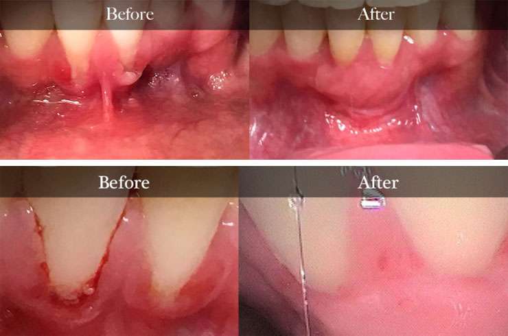 Before and After Emdogain 