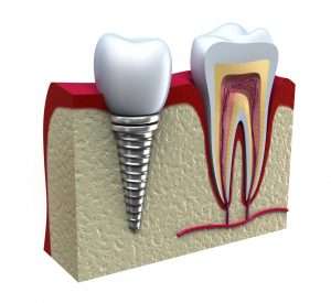 Dental Implant Anatomy