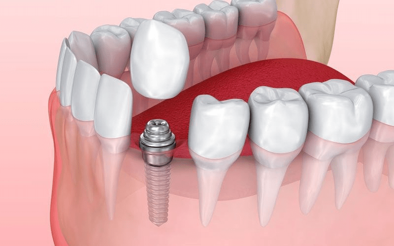 Low Cost Dental Implants