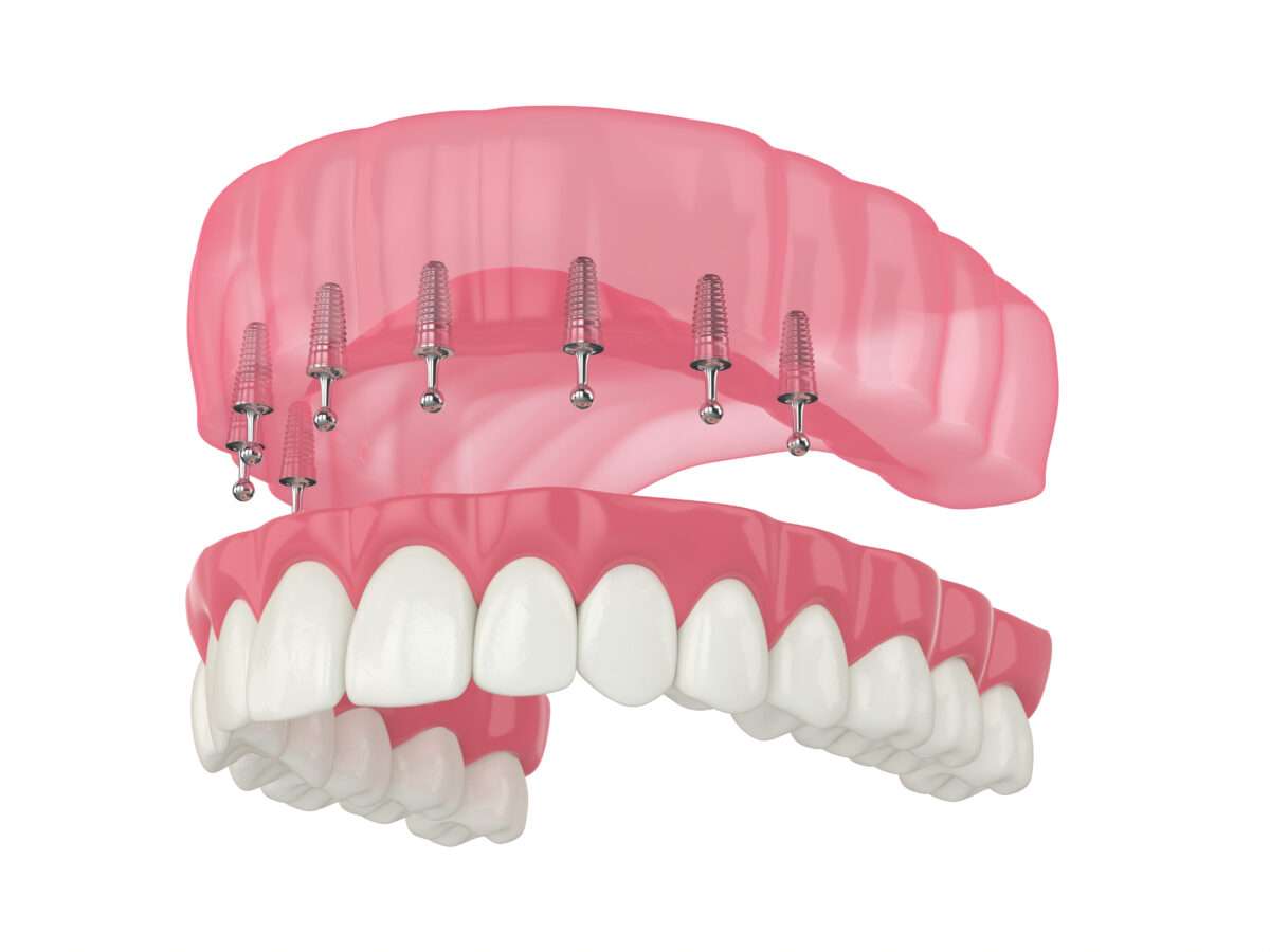 overdenture