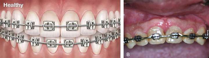 Healthy Gums