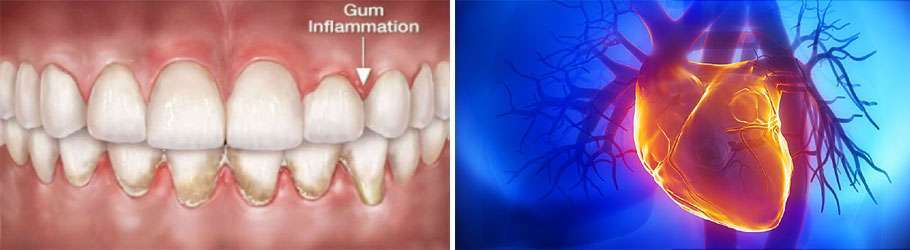 Gum Inflammation and Heart Health