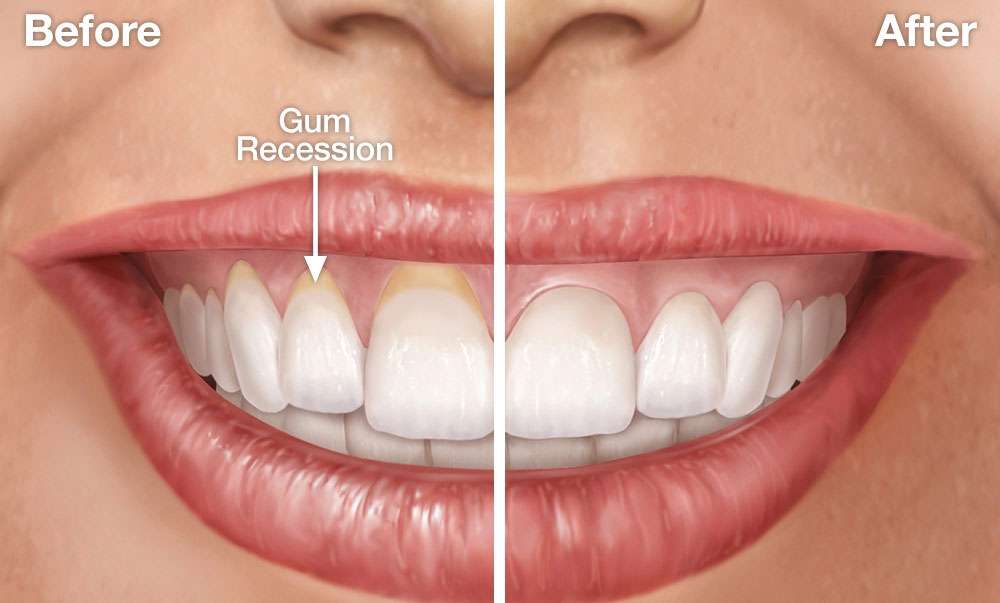 Receding Gums Stages