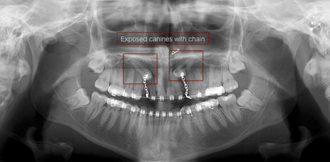 X-Ray of Impacted Teeth with Chains
