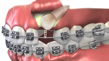 Correction for Impacted Teeth 