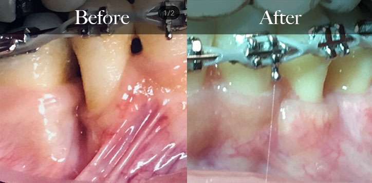 Connective Tissue Graft