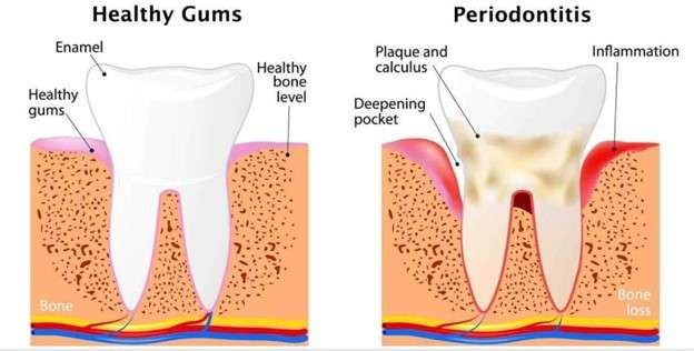 Healthy Gums Vs Periodontitis