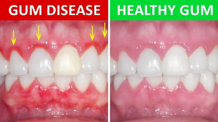 Gum Disease Vs Healthy Gums