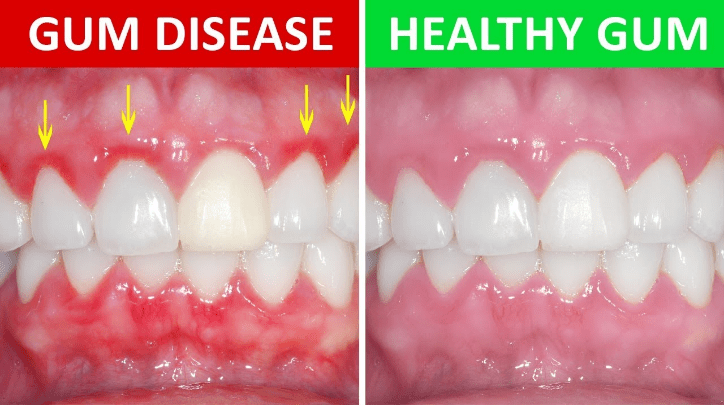 Stages of Periodontal Disease