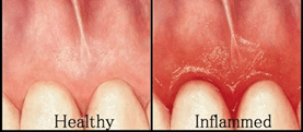 Healthy Vs Inflamed Gums