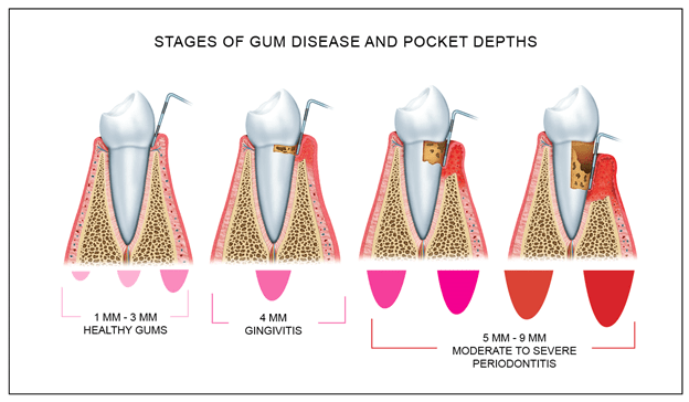 Stages of Gum Disease