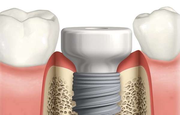 Healing Abutment