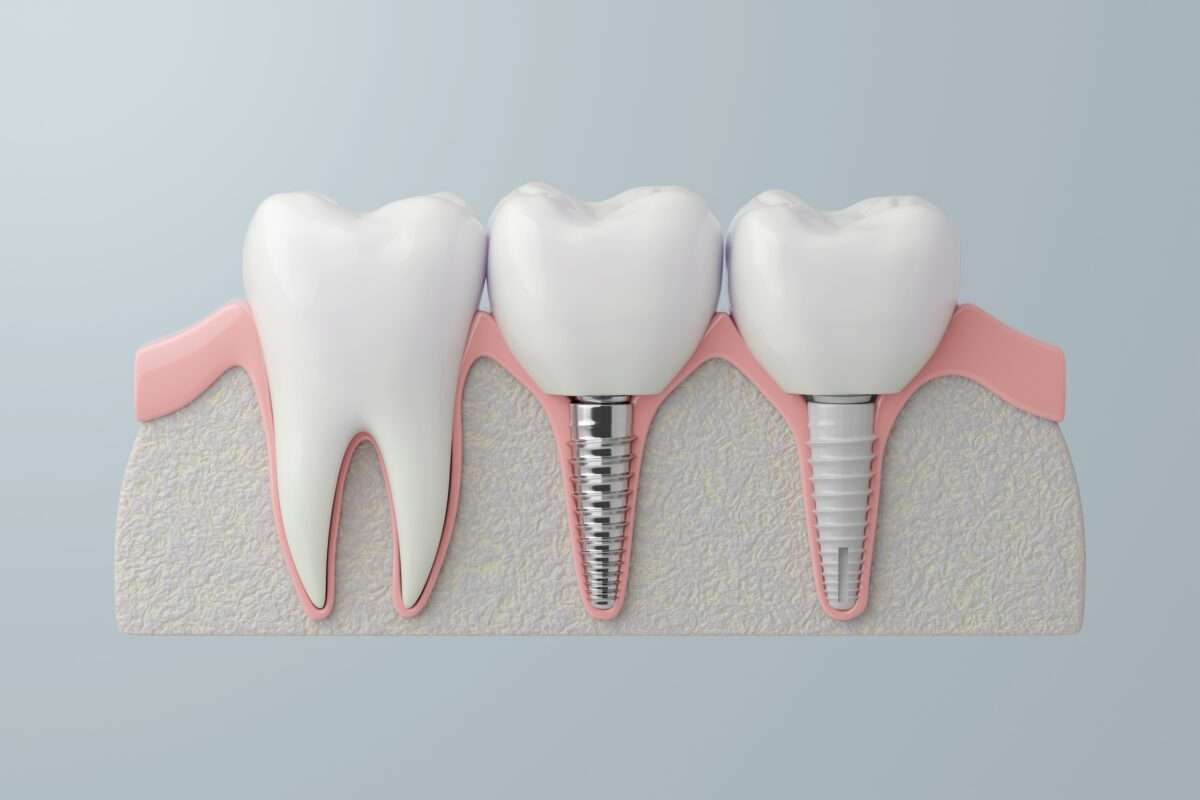 implant types