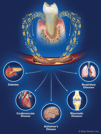 Diseases Caused by Periodontal Disease