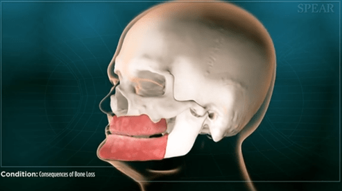 Consequences of Bone Loss