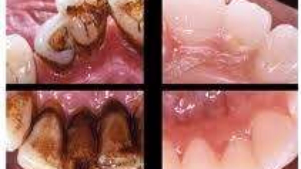 tobacco in gums Smoking and Periodontal Disease