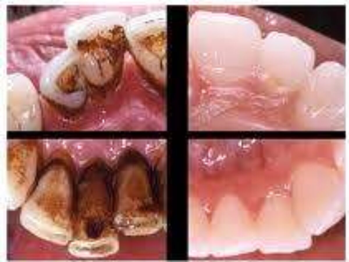tobacco taste in mouth non smoker Smokeless Tobacco: Meaning, Side Effects, Causes Explained Smoker's palate Smoker's palate refers
