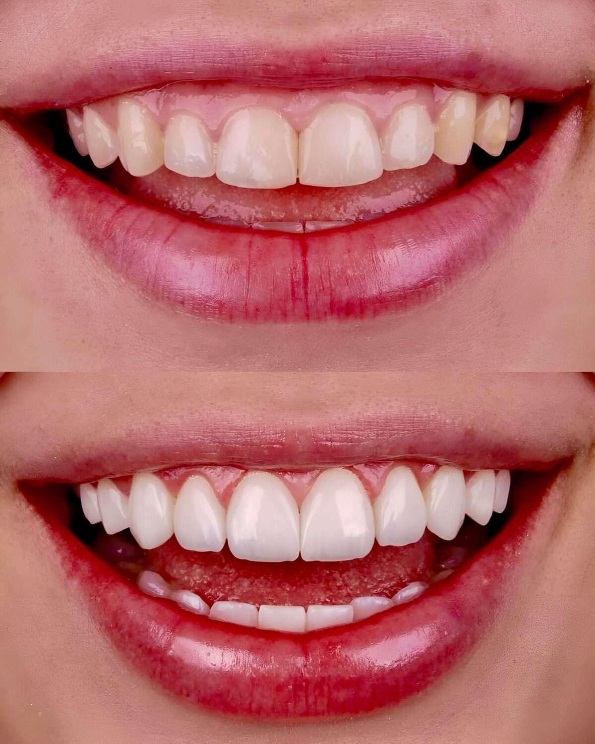 gummy smile reversal