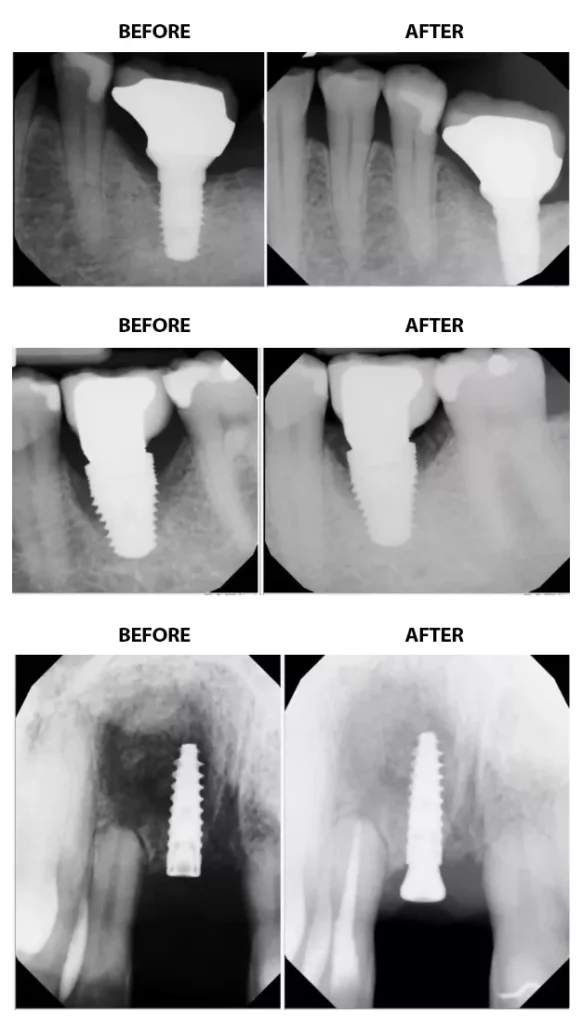 Before and After Implant Repair