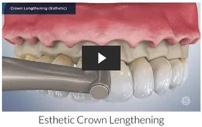 crown lengthening 
