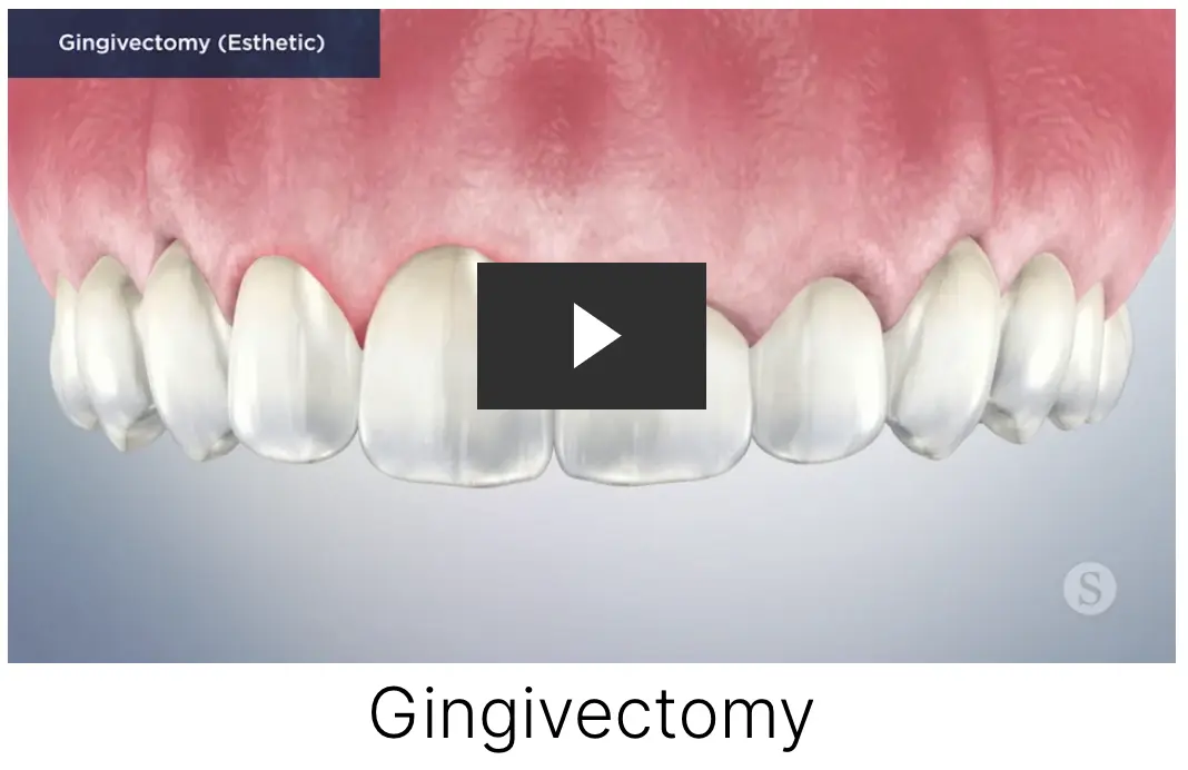 gingigvectomy