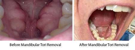 Mandibular Tori Removal