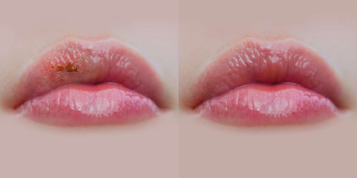 cold sore erasure