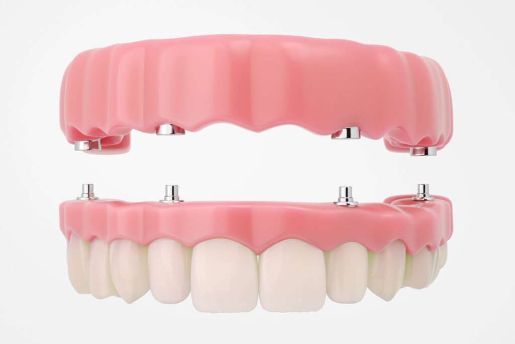hybrid dentures