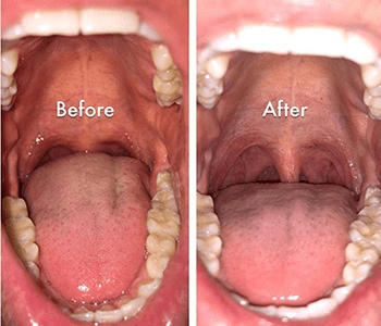 Side-by-side comparison of a mouth: left shows 'Before' with missing teeth and plaque; right shows 'After' with clean gums after dental treatment.