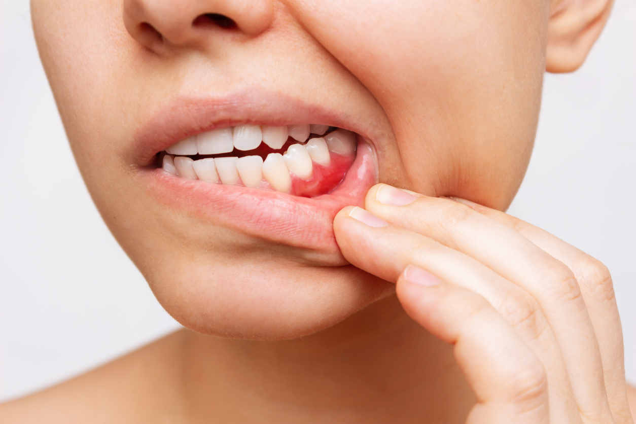 Close-up of a person pulling down their lower lip to reveal red, irritated gum near the lower teeth taking focus on dental inflammation/sores.